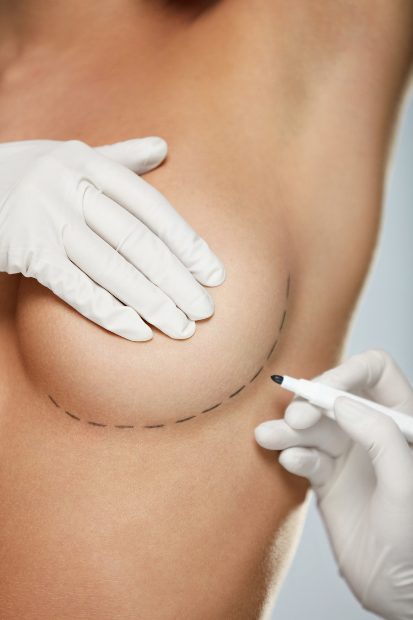 Comprendere la Mastoplastica: Un approfondimento sulla chirurgia del seno